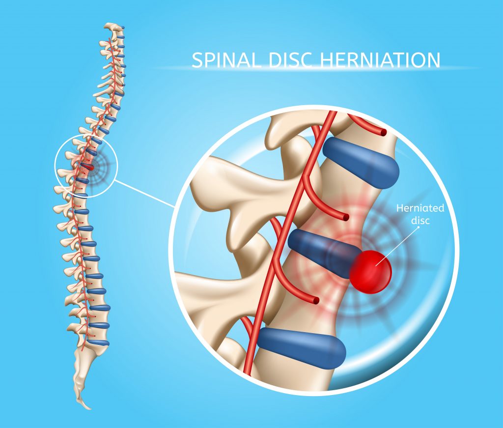 Could Your Back Pain Be a Herniated Disc? - Spinal Disc Herniation