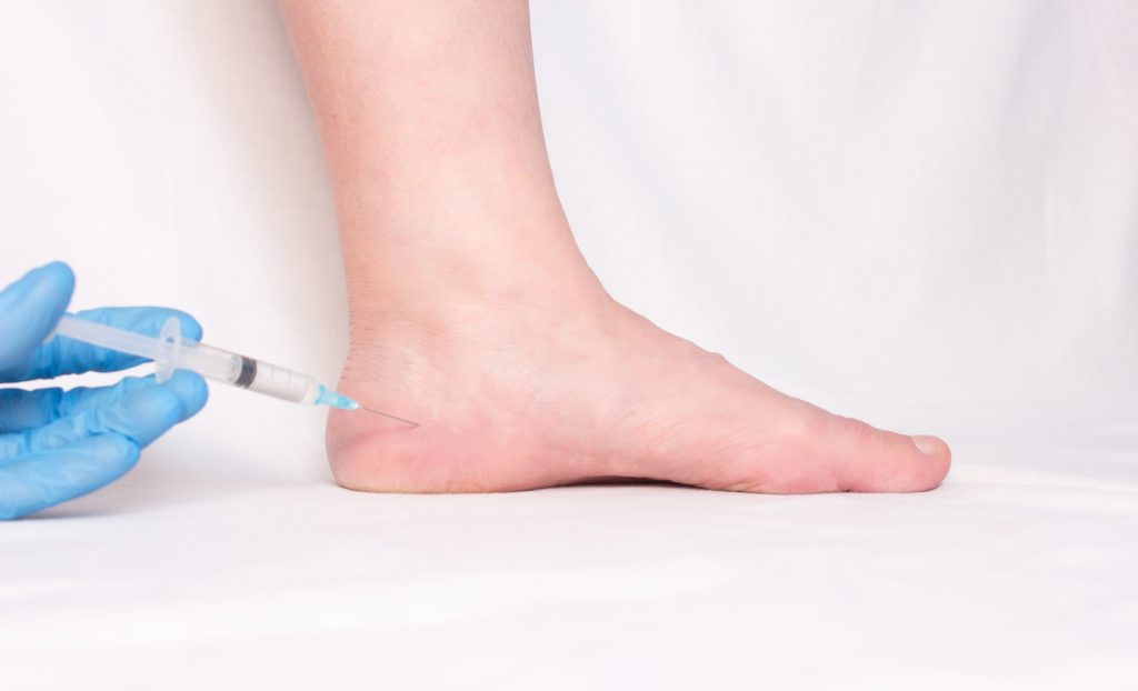 Steroid Injection In Heel Plantar Fasciitis