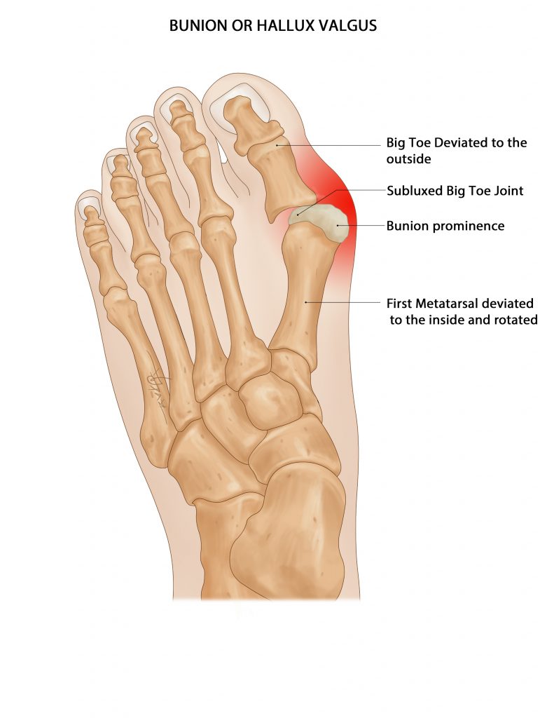 Why Is Lapiplasty A Better Bunion Surgery? - Bunion Or Hallux Valgus