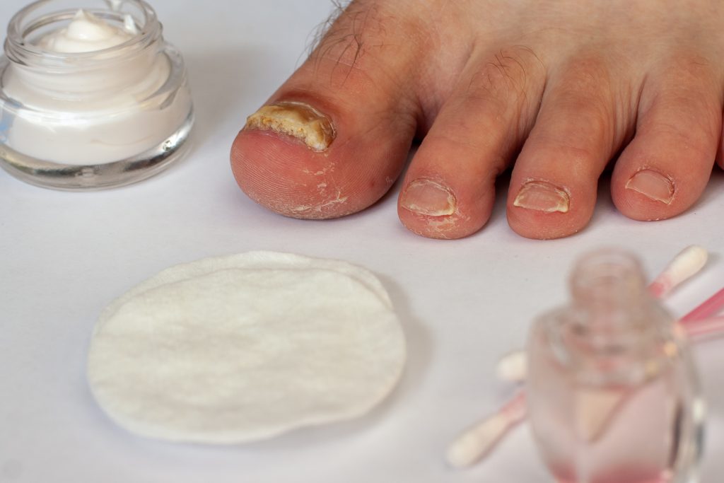 Toenail Fungus Ointment