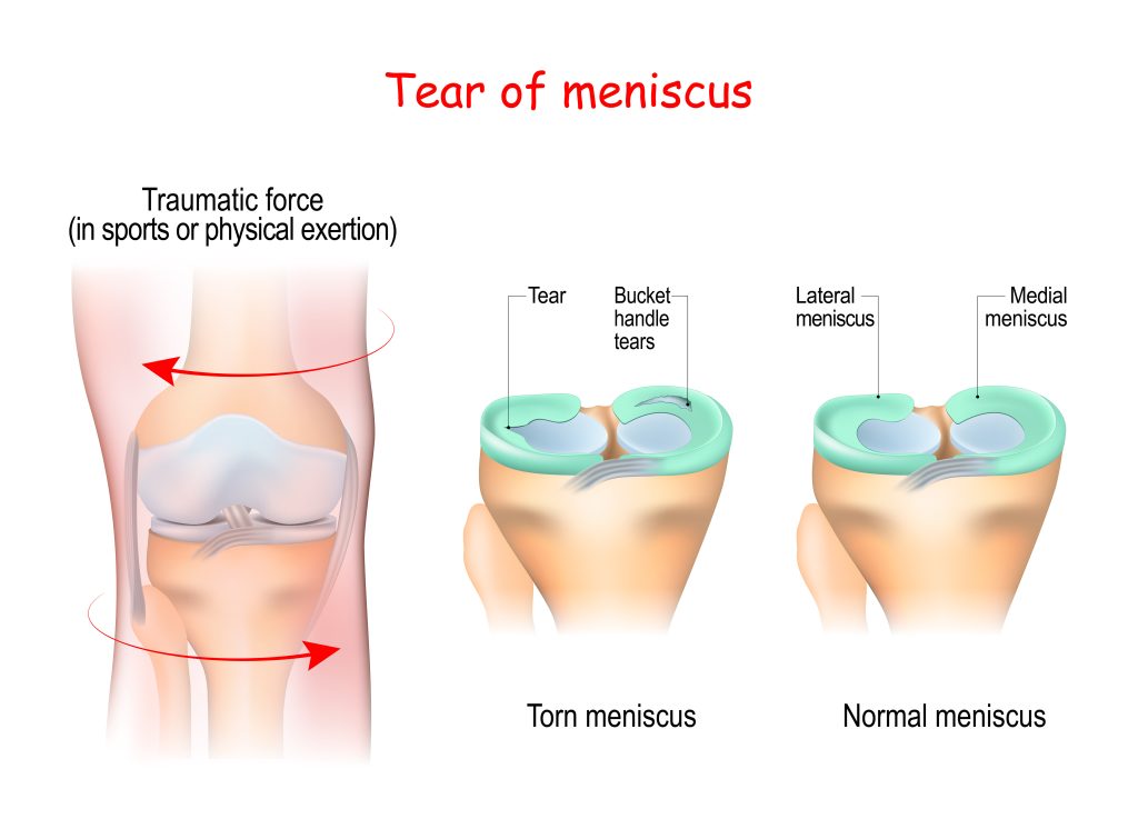 meniscus tear