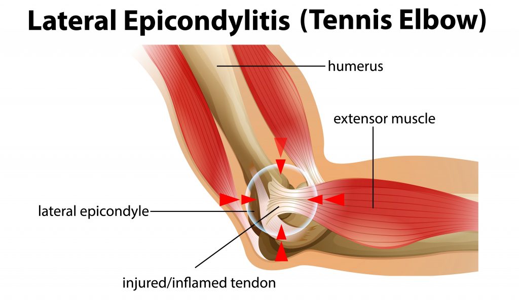 The Difference Between Tennis Elbow And Bursitis - Tennis Elbow Illustration