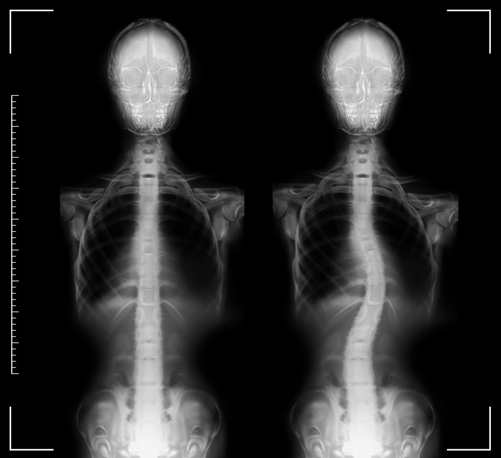 scoliosis xray