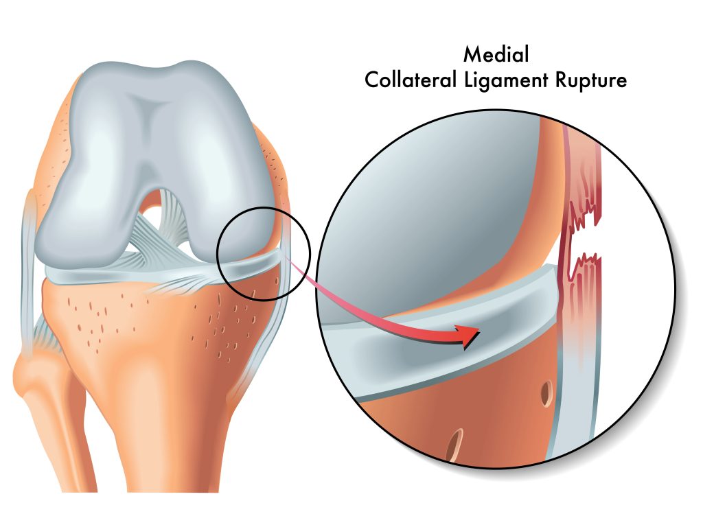 collateral ligament tear