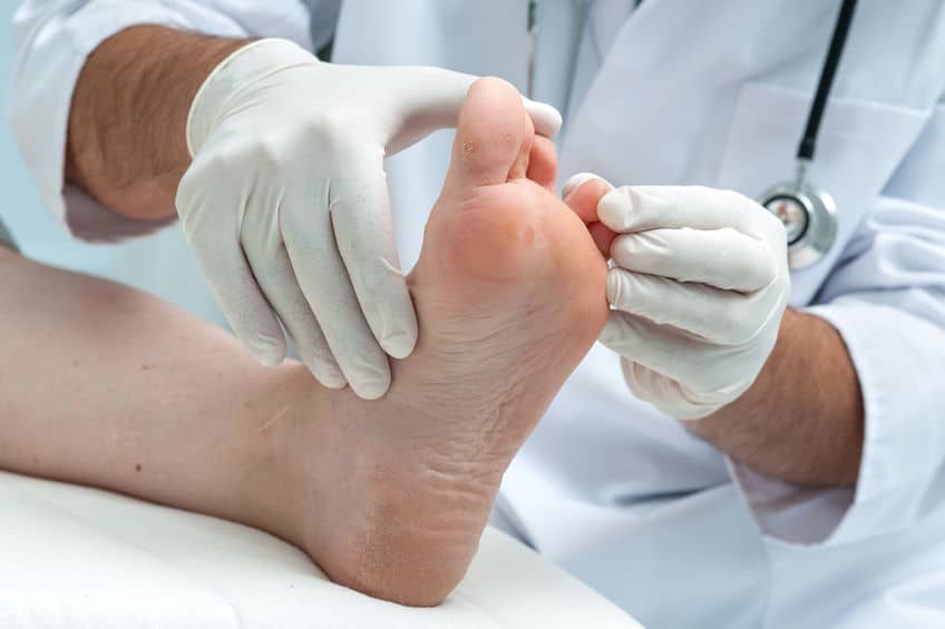 How to Treat Hammer Toe