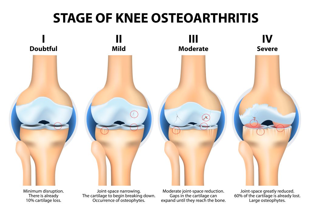 stages of knee osteoarthritis