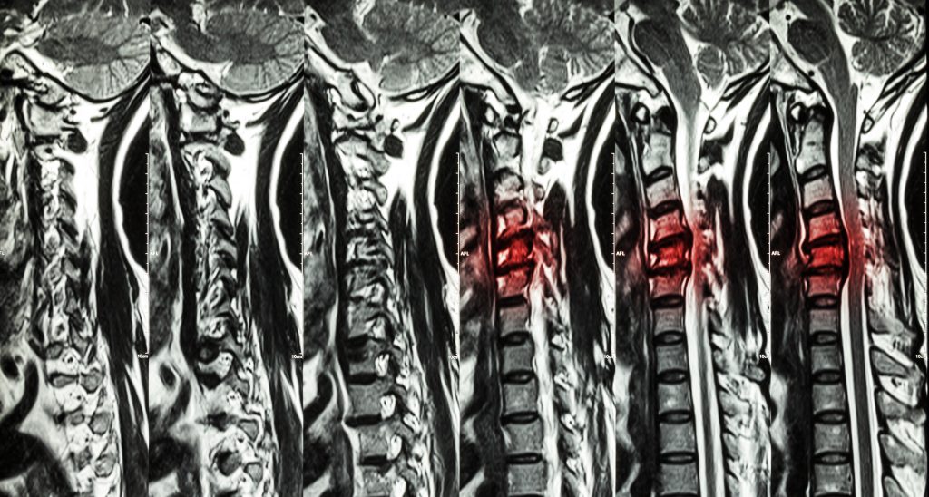 Could Your Back Pain Be a Herniated Disc?
