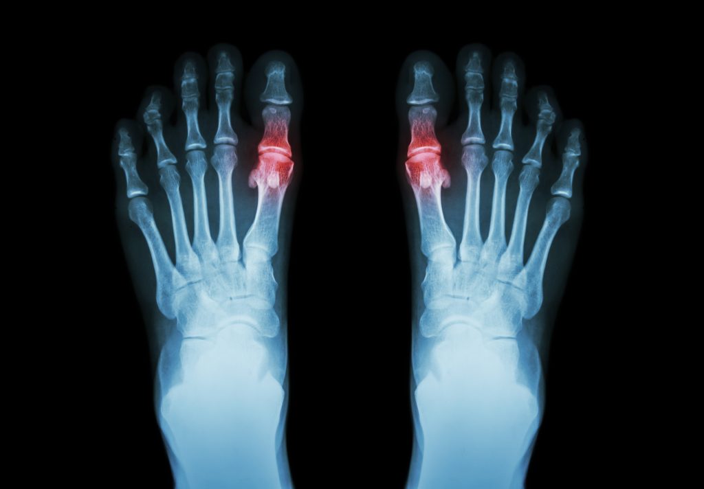 How To Tell If You Have Gout