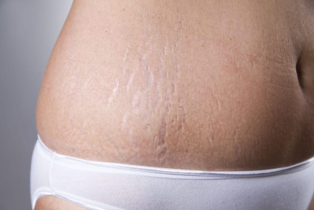 Scar Treatment & Prevention at Warner Orthopedics & Wellness