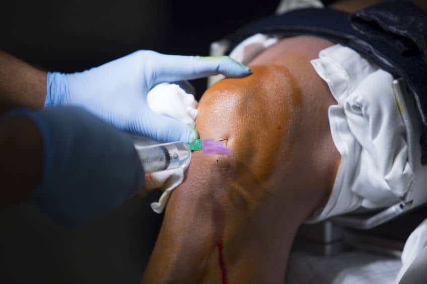 What is Arthroscopy?