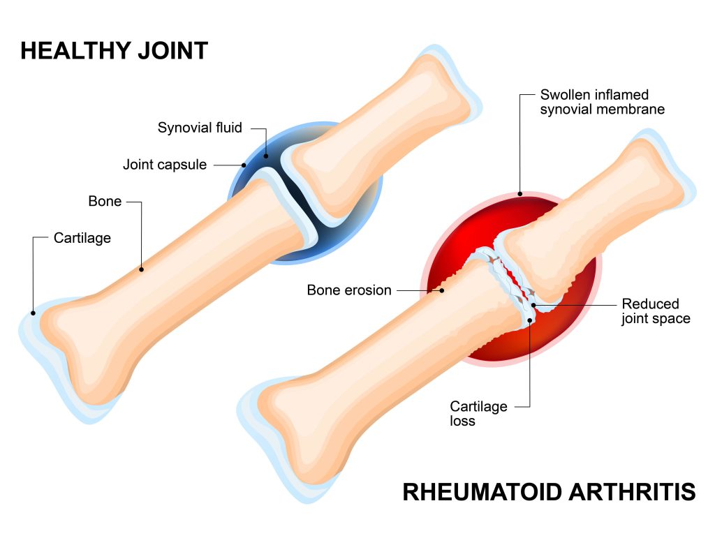 rheumatoid arthritis vs healthy joint