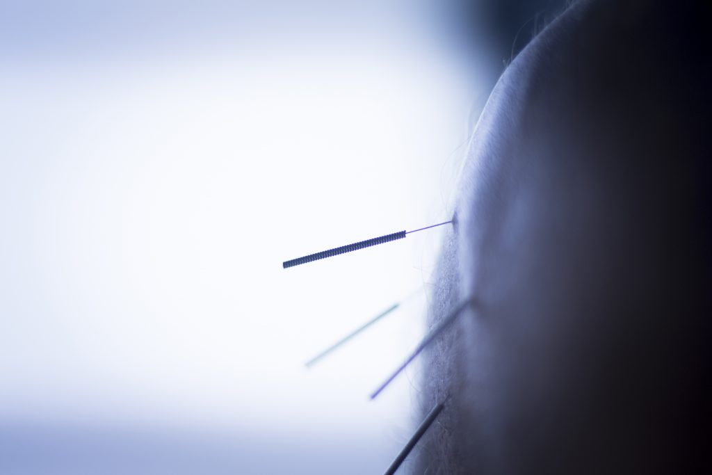 Dry Needling VS Acupuncture