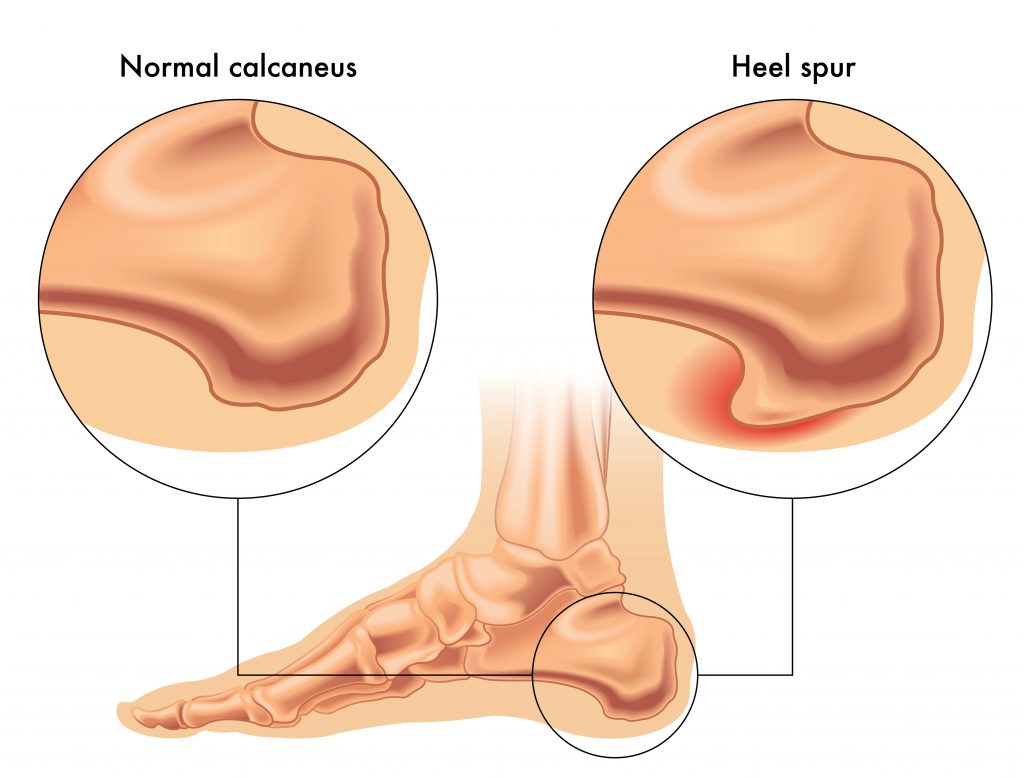 Orthopedics: How Do I Treat Heel Pain? Heel Spur