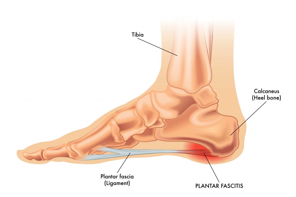Why is Plantar Fasciitis so Hard to Heal? - Plantar Fasciitis Diagram