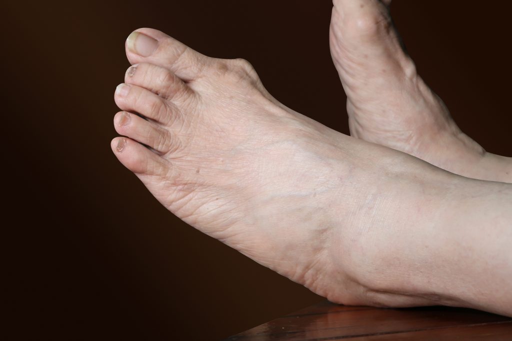 feet with bunions