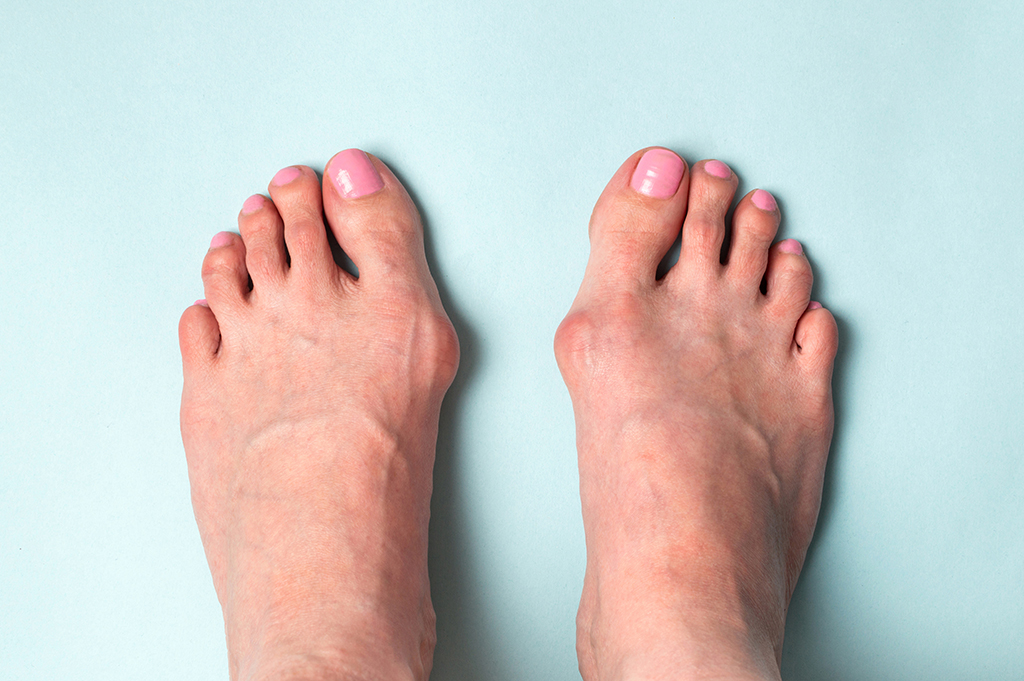 Bunion Care At Warner Orthopedics & Wellness