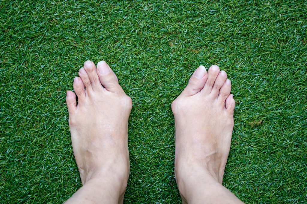 Why Is Lapiplasty A Better Bunion Surgery?