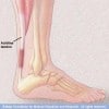Achilles Tendinitis