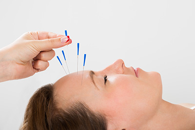 Surprising Treatment Options For Migraines - Acupuncture