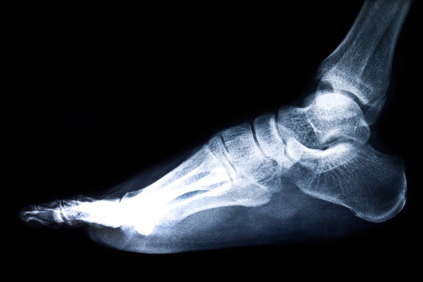 What is Ankle Arthritis?