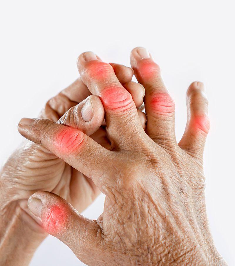 What Is Acute Arthritis? And Your Treatment Options -Hand Pain
