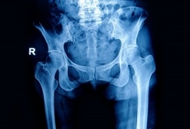 Orthopedic Surgery to Replace to the Hip Joint