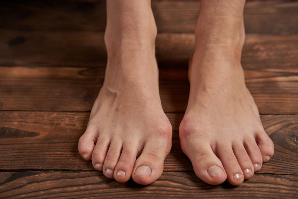Lapiplasty VS Traditional Bunion Surgery
