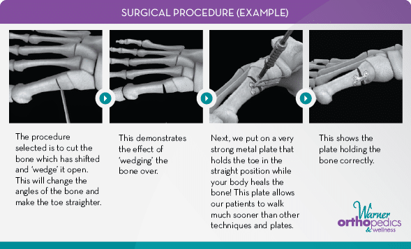 How to Know if You Have a Bunion
