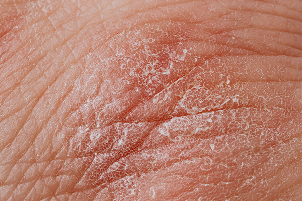 Signs You Need An Omega-3 Supplement - Dry Skin